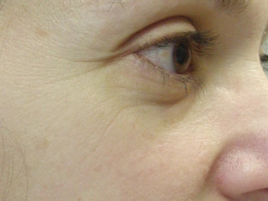 Radiance Lifting Κρέμα Ματιών Πριν