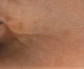 Radiance Peeling Ορός Μετά