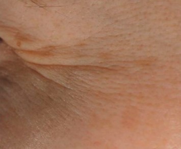 Radiance Peeling Ορός Πριν